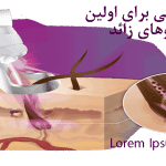 راهنمای نهایی برای اولین جلسه لیزر موهای زائد