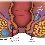 آبسه مقعدی و عوارض آن + درمان خانگی و جراحی