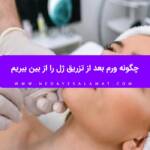 چگونه ورم بعد از تزریق ژل را از بین ببریم