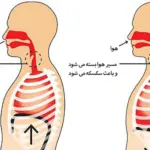 درمان سکسکه