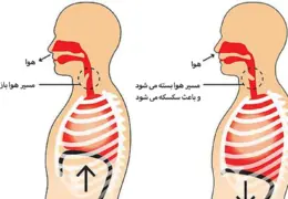 درمان سکسکه