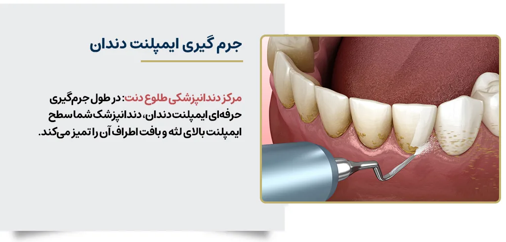 جرم‌گیری و پولیش ایمپلنت دندان